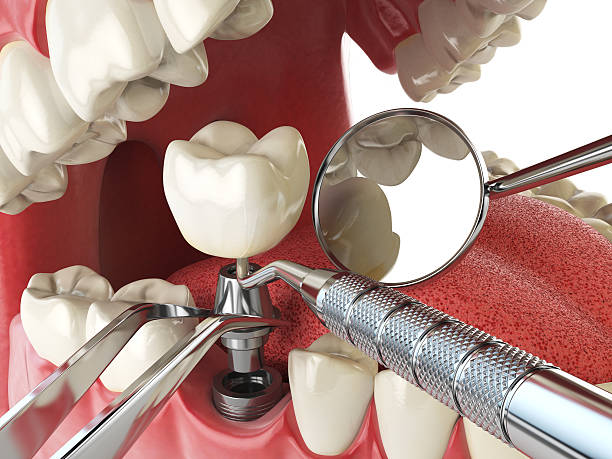 Best Emergency Root Canal Treatment in Rugby, ND